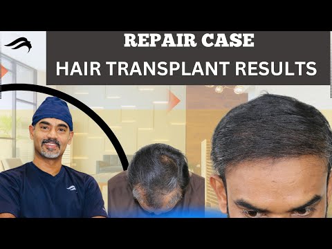 Hair Transplant In Bangalore | Best Cost Clinic &...