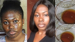 I USED THIS SOLUTION TO GET RID OF DARK SPOTS IN 7 DAYS