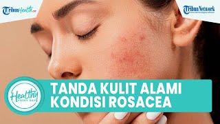 Kerap Alami Kulit Bintik Kemerahan dan Terasa Gatal? Bisa Jadi Tanda Gangguan Kulit Rosacea