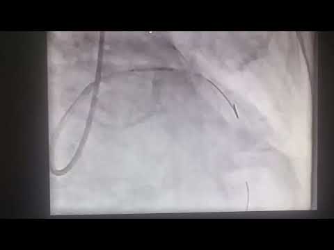 T Stenting technique