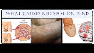 What Causes Red Spots on the Penis and How Are They Treated.البقع الحمراء على القصيب السبب والعلاج