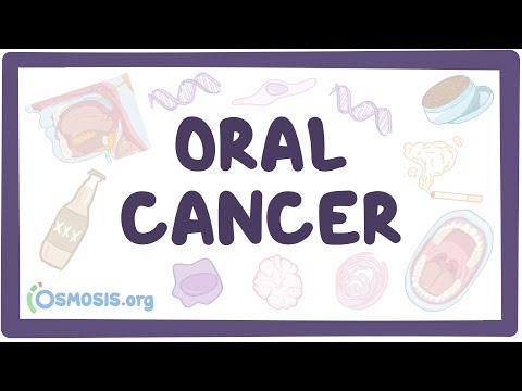 Oral Cancer - causes, symptoms, diagnosis, treatment, pathology