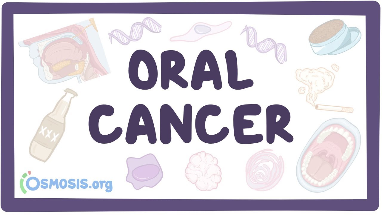 Oral Cancer - causes, symptoms, diagnosis, treatment, pathology