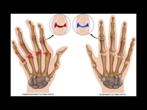 Csípőízület deformáló artrózisának kezelése