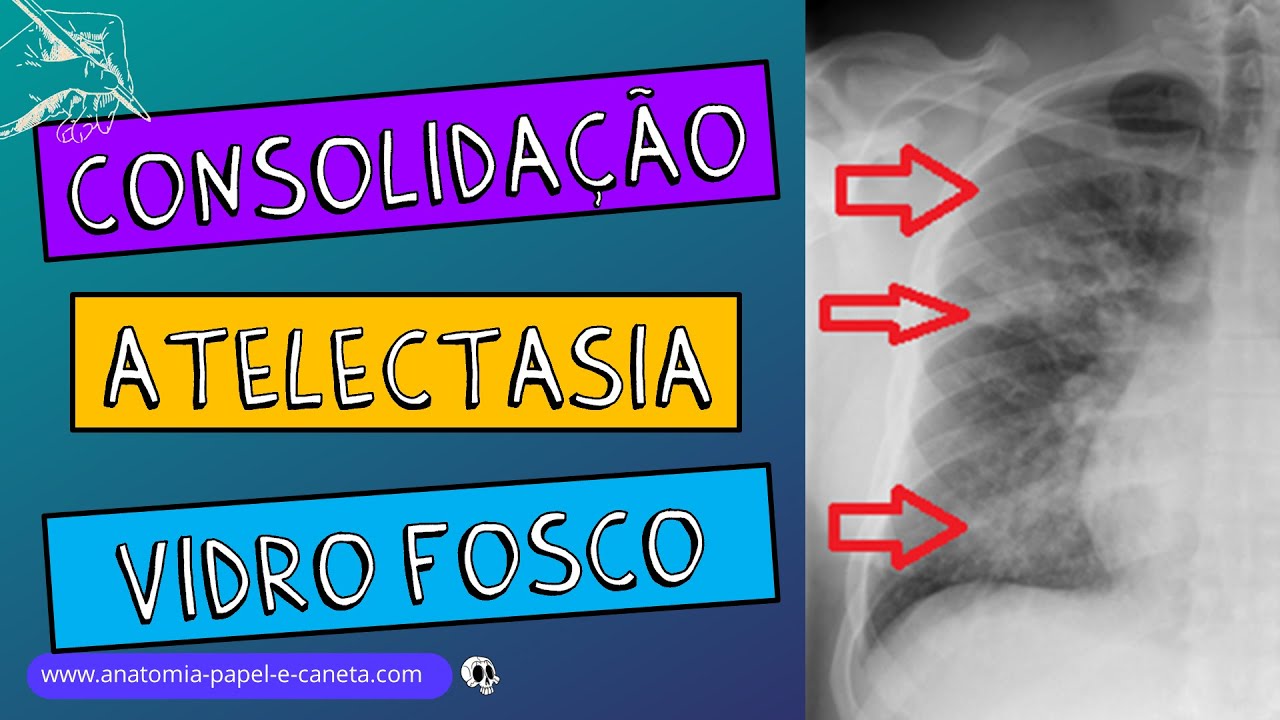 Pulmões no RX - Parte 1/2 - CONSOLIDAÇÃO - ATELECTASIA - VIDRO FOSCO