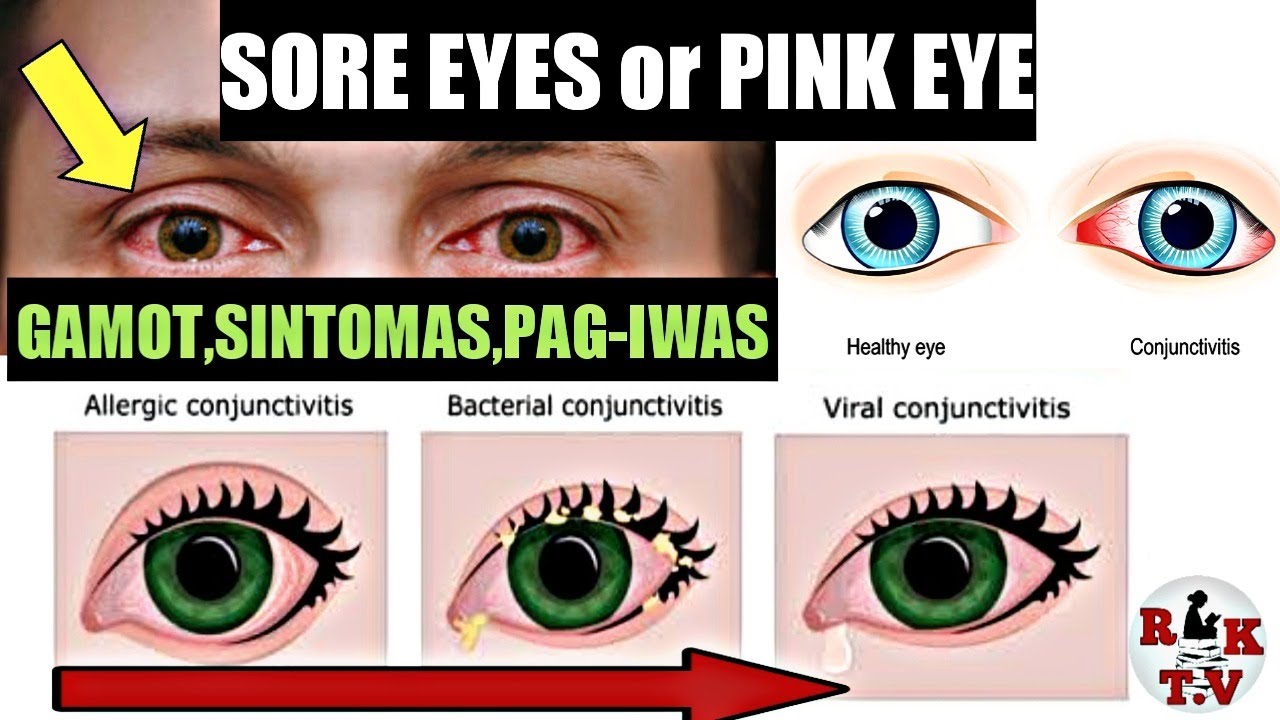 GAMOT o LUNAS SA SORE EYES SINTOMAS AT PAANO MAIIWASAN ANG SORE EYES | CONJUNCTIVITIS (PINK EYE)