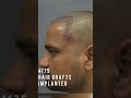 5 Months Hair Transplant Results Before After Hairtransplantinindia