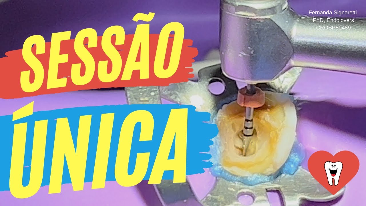 ENDODONTIA SESSÃO ÚNICA EM 3 PASSOS - Endolovers