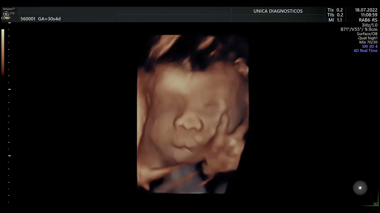 Ultrassom 4D HD Live - 11