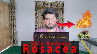 Skin Redness Treatment | Rosacea | How To Get Rid Of Face Redness | Beauty Facts