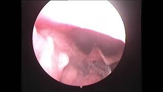 Fish Bone Removal from deep inside Throat