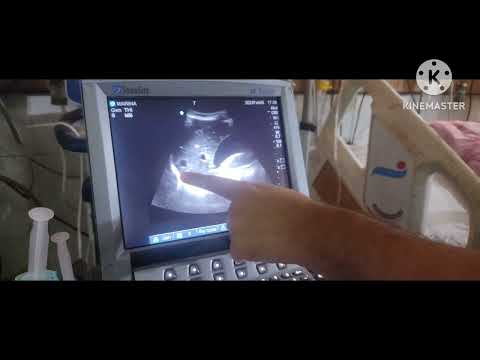 Diaphragmatic Excursion// POCUS// Weaning Predictor// TTCCM