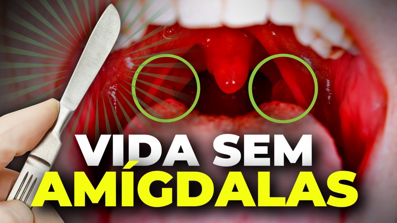 O perigo SUBESTIMADO de TIRAR AS AMÍGDALAS