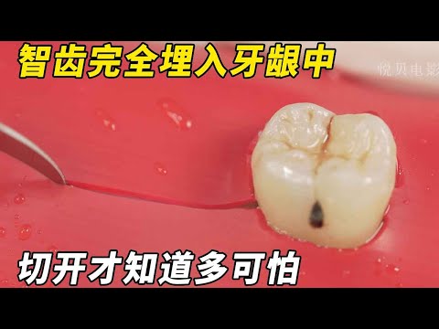 这颗智齿竟然横着长，完全埋进了牙龈里，简直不要太痛苦！！【悦贝电影】