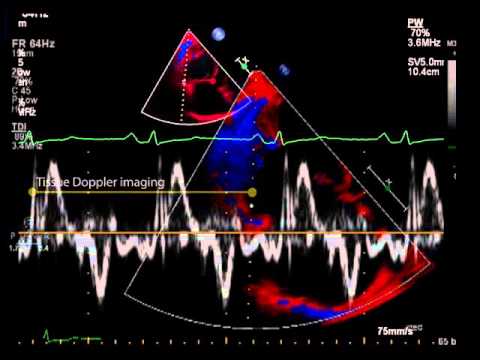 21. Tissue doppler imaging of the free wall of the RV at the tricuspid annulus