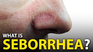 How To Get Rid Of Seborrheic Dermatitis? (DANDRUFF)