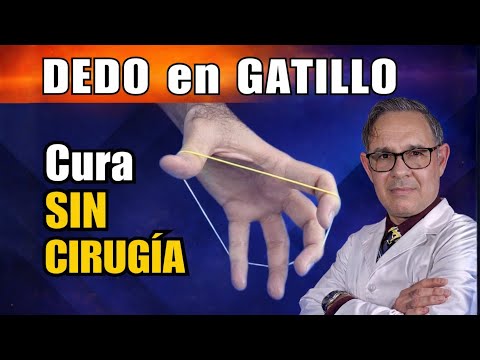 DEDO en GATILLO (o resorte): EVITA la CIRUGÍA con este TRATAMIENTO EFECTIVO
