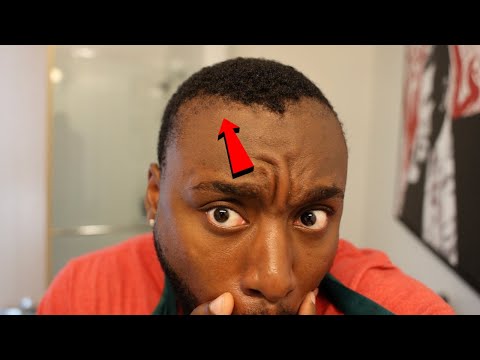 ITS HAPPENING... MY HAIRLINE SURGERY IS WORKING!?