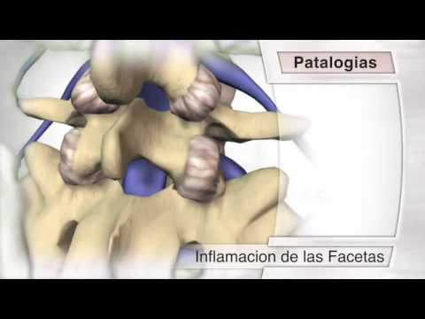 El síndrome facetario