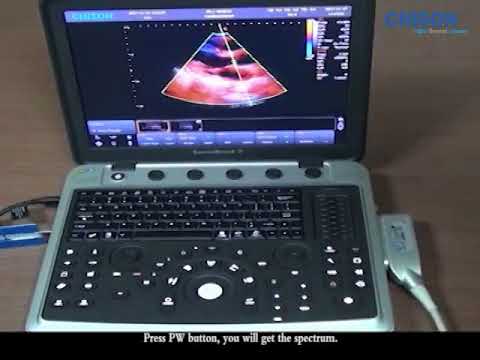 Echocardiogram Machine - Echo Machine Latest Price, Manufacturers ...
