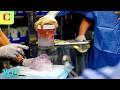Human Receives Gene Edited Pig Kidney From Xenotransplants What The Future