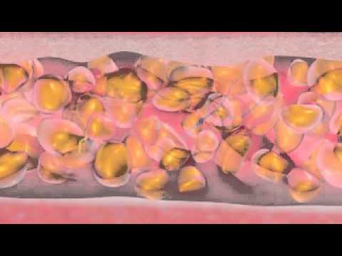 How BodyJet WaterAssisted Liposuction WAL Works