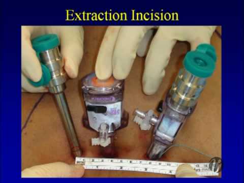 Nefrectomía radical robótica de incisión unica