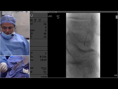 Stern D2 - Live Case #4 - Mount Sinai