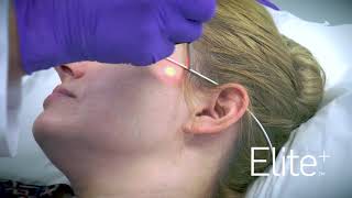 Laser Skin Rejuvenation: Fast...Painless...Effective!