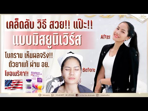 เมโสแฟต ยี่ห้อไหนดี