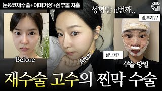 성형만 n번째… 찐막 수술 브이로그(눈재수술+코재수술+이마거상)