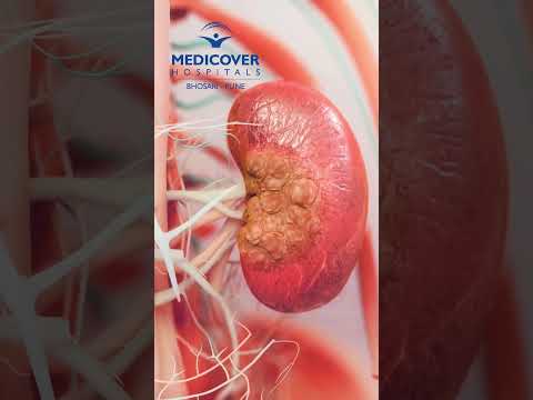 Blood In Urine , Reasons, Diagnosis and Treatment |Dr. Sumit Chaudhari