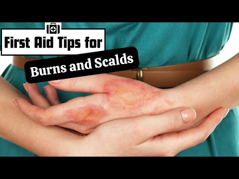Essential First Aid for Burns and Scalds: Quick Steps to Relieve Pain
