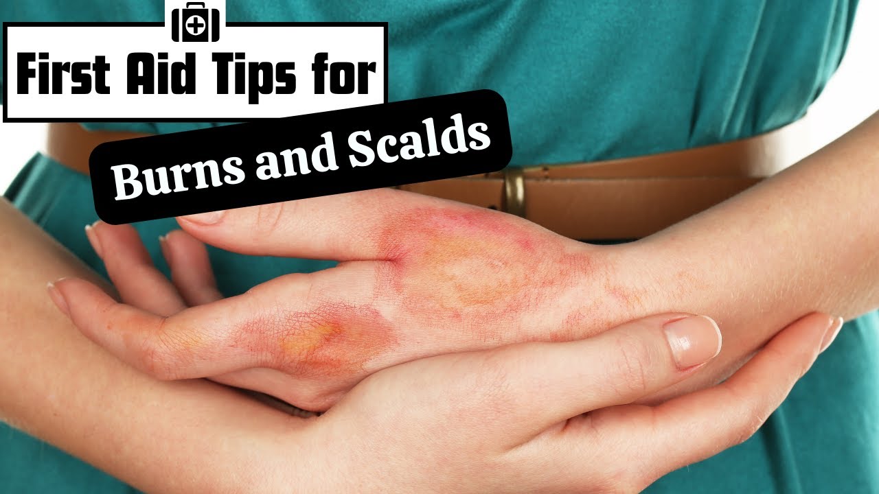 Essential First Aid for Burns and Scalds: Quick Steps to Relieve Pain