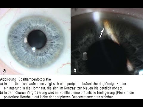 Kayser Fleischer Kornealring bei Morbus Wilson