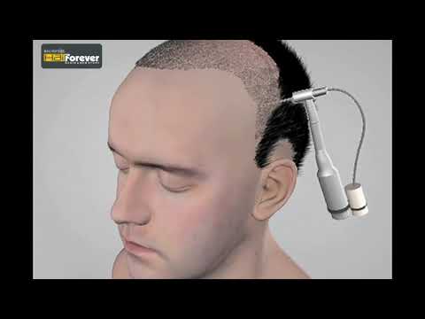 Fue Hair Transplant Service in India Fue Hair Transplant Service in India