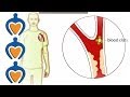 Thrombosis What Is It And How Is It Treated