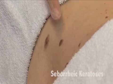 Der Sud aus dem Hafer und die Schuppenflechte Suprastin in den Einstichen beim Ekzem