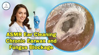 ASMR Ear Cleaning | Chronic Earwax and Fungus Blockage | Satisfying Relief | Ear Wax Removal | Relax