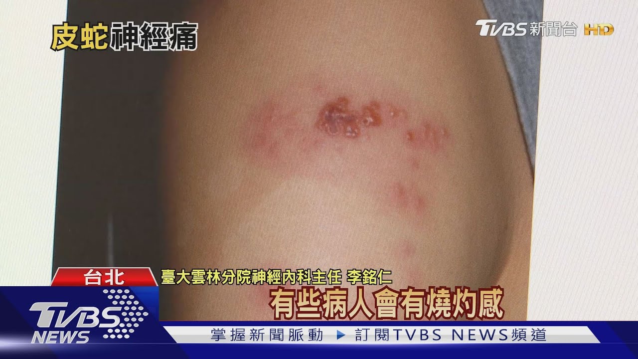 「皮蛇」只會纏上中老年人？治療晚一步　失明、失聰風險增！