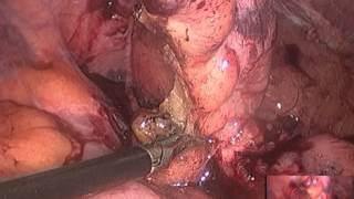laparoscopic appendectomy -difficult  case by  dr riadh alani