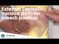 External Cephalic Version (ECV) for breech ...