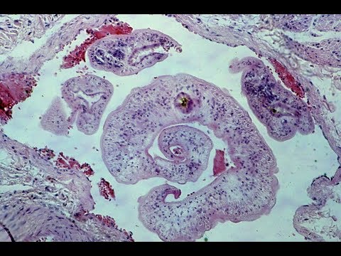 Papiloma cancer garganta