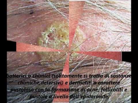 Le malattie prese per psoriasi Cura di psoriasi di medicine antifungosa