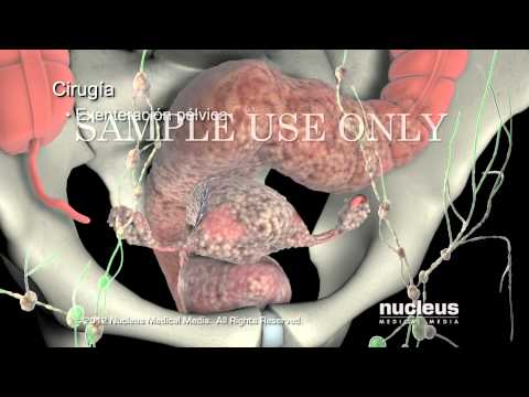 Tratamientos para el cáncer de cuello uterino