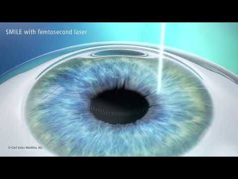 Regos korekcija SMILE PRO metodu I LIREMA