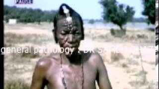 general pathology 21:sarcoidosis leprosy rhinoscleroma   DR SAMEH GHAZY