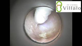 耳掃除動画vol.34「自分では取れなくて…」