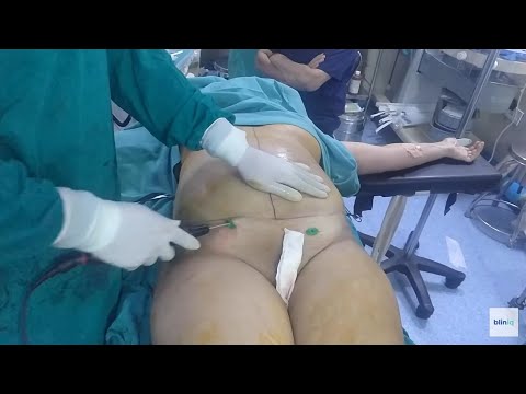 Patient Recovery Case — Video 27 (Gynecomastia)