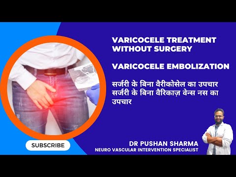 Varicocele treatment without surgery /varicocele embolization| Dr. Pushan Sharma 